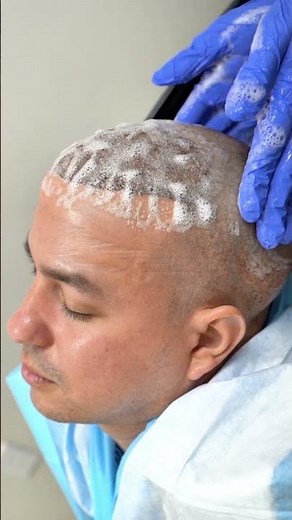 Hair transplant. Before and After of our patient | Care4Hair