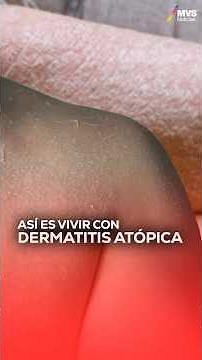 🧴 This is what it's like to LIVE with ATOPIC DERMATITIS
