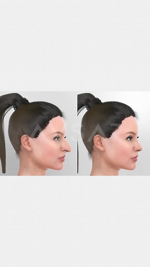 Yakup Avsar | Alar reshaping, also known as alar base reduction or alarplasty, is a surgical procedure commonly performed in rhinoplasty to alter the... | Instagram