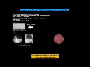 Case Of Primary Bladder Neck Obstruction: Transurethral Bladder Neck Incision: Dr SHIVANSHU -UROLOGY
