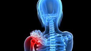 Rotator Cuff Tears of the Shoulder