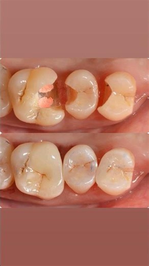 Cusp capping and multiple class 2 restorations.