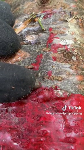 Satisfying Tree Pimple Popping Videos
