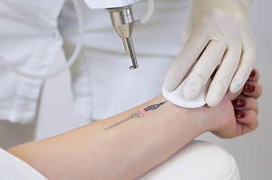 Tattoo Removal - Sacramento, CA | Emil A. Tanghetti, MD