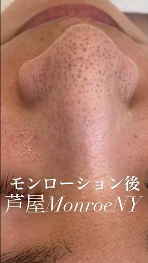 【毛穴の黒ずみ】エクストラクションで根本から角栓除去して引き締めていきましょう
