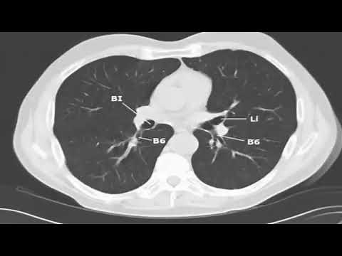 CT lung segments of bronchus