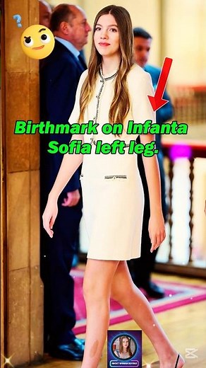 Birthmark on Infanta Sofia left leg