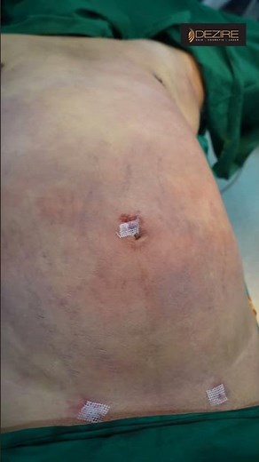 Gynecomastia and Abdomen Liposuction