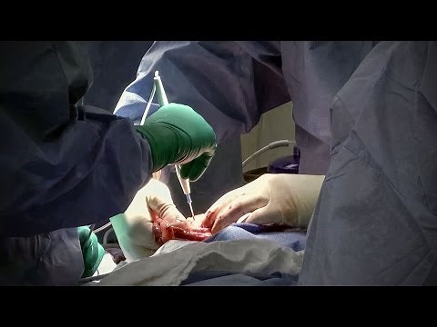 Laparoscopic vs Open Resection for Rectal Cancer