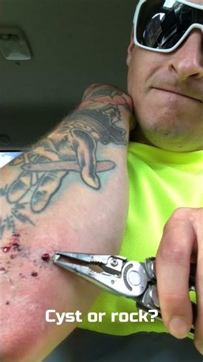 Cyst or rock?