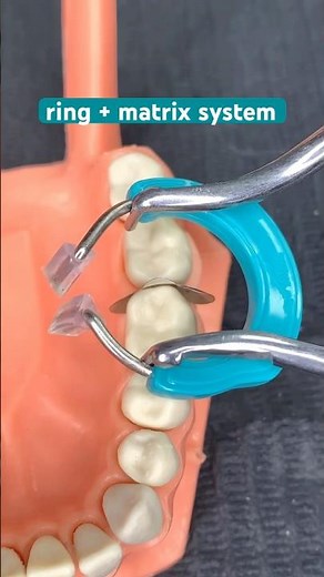 Class II Restoration with Garrison Ring Matrix Perfect Contact