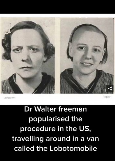 Disturbing Before and After Photos of Lobotomies