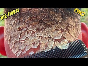 DRY SCALP !! Big Flakes Dandruff Scratching Satisfying Video #793