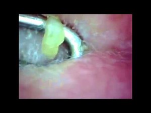 Popping Grandma's Back Zits