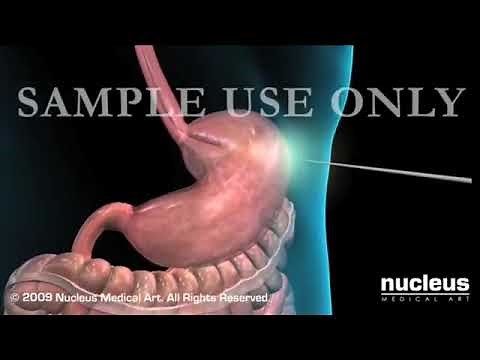 What is Percutaneous Endoscopic Gastrostomy (PEG)