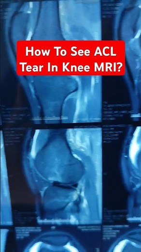 How To See ACL Tear In Knee MRI ? Dr Sai Chandra