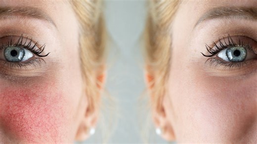 Rosacea erkennen: Ursachen, Anzeichen und Behandlung für die Hautkrankheit im Gesicht