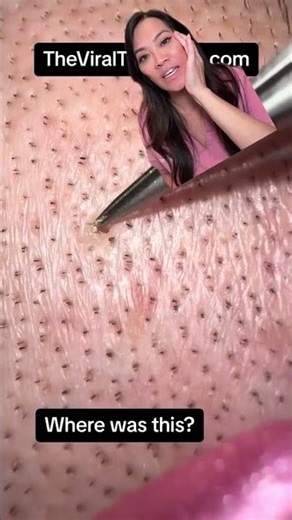 These are clogged hair follicles ✨