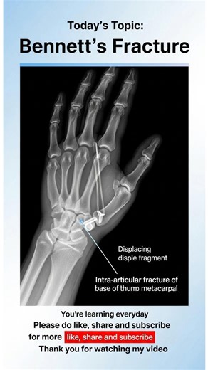 Bennett's Fracture #fmge #neetpg #important #ytshorts #trending #subscribe for your upcoming Exam 😘