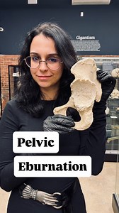 The Bone Museum on Instagram: "🦴 Ever seen bone so smooth it looks polished like ivory? That’s called eburnation, a tell-tale sign of chronic joint damage. In this pelvis, years of friction wore away the cartilage, leaving the bone to grind directly against bone, creating this glossy, marble-like surface. It’s osteoarthritis written in bone."