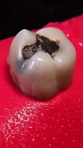 Dental crown procedure #dentist #dental #teeth #crown #procedure