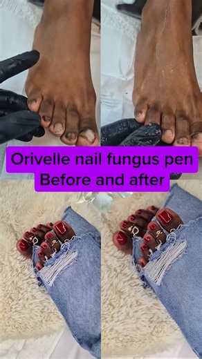 Tired of hiding your nails? 💅 Say hello to open-toe confidence in just 2 weeks. The Orivelle Nail Pen doesn't just cover up the problem—it goes deep to fight the fungus at its source. ✅ Targets the nail root ✅ Easy 10-second daily application ✅ Noticeable results in days ✅ Backed by science and a 30-day guarantee Don't wait for it to spread. Start your treatment today | Dr. Emily Harper