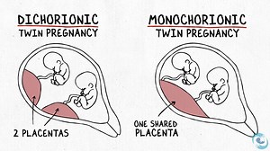 The Difference Between Dichorionic and Monochorionic Twins - UCSF Pediatrics