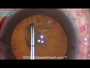 CataractCoach™ 2633: The Little Capsulorhexis Rescue Technique