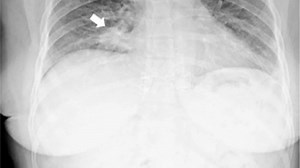 'Healthy' mum riddled with cancer stuns doctors with surprising first symptom