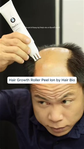 Hanya 5 menit setiap malam untuk rambut lebih tebal dalam 2 minggu! 💪 Perawatan efektif untuk rambut rontok dan stimulan pertumbuhan rambut: Bahkan jika Anda telah lama menderita rambut menipis, rambut rontok, atau kebotakan… Anda masih dapat menumbuhkan kembali rambut hitam, halus, dan sehat. ✨ Stimulan pertumbuhan rambut alami – aman, menutrisi akar dan folikel rambut dari dalam. 💦 Bahan-bahan: – 2 bahan aktif yang terbukti secara ilmiah (Peel Ion dan Bahan Aktif Ilmiah) – 6 ekstrak alami: M