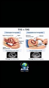TVS (Transvaginal Sonography) and TAS (Transabdominal Sonography) are two ultrasound methods used to examine the uterus, ovaries and early pregnancy. The main difference is the position of the probe. In TVS, the probe is placed inside the vagina, so the organs are seen very closely and clearly. In TAS, the probe is moved over the lower abdomen and images are obtained through the abdominal wall. (TVS vs TAS) 1. TVS – Transvaginal Sonography Probe is inserted into the vagina. Gives clear and detai