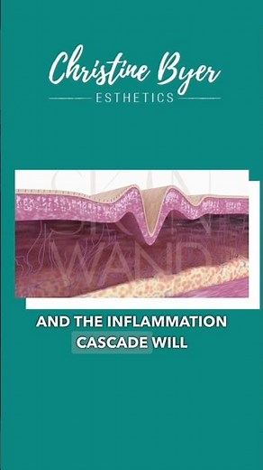 The Power of Micro-Channeling!