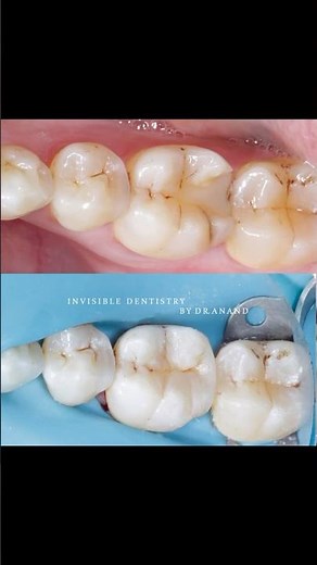 Class 2 restoration using Garrison’s Sectional Matrix System