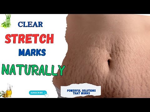 CLEAR STRETCH MARKS NATURALLY WITH 15 EFFECTIVES REMEDIES (From Stripes to Smooth)