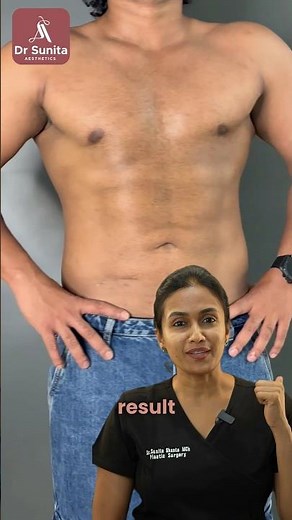 Gynecomastia Before and After Result┃Dr. Sunita Aesthetics┃Best Surgeon In Vizag