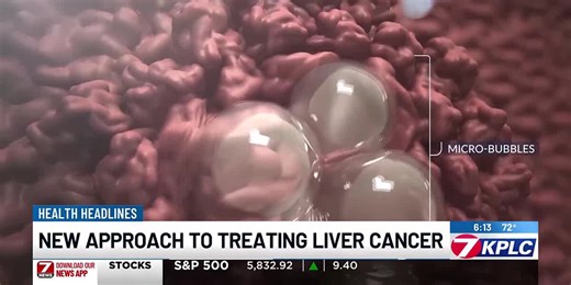 New FDA-approved approach to treating liver cancer