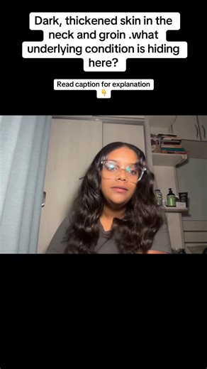 Key points for this case: \t1.\tDistribution and appearance: \t•\tHyperpigmented, velvety plaques in intertriginous areas (neck, axilla, groin) \t•\tCan be mildly pruritic \t2.\tMost common causes: \t•\tInsulin resistance: obesity, type 2 diabetes, PCOS \t•\tEndocrine disorders: Cushing syndrome, hypothyroidism, acromegaly \t•\tMalignancy-associated: sudden, severe, widespread often gastric adenocarcinoma \t•\tDrug-induced: nicotinic acid, steroids, oral contraceptives \t3.\tWhy this patient fit