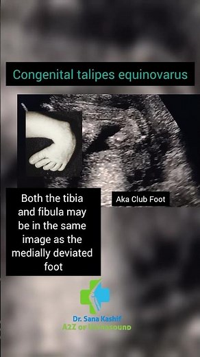 Congenital Talipes Equinovarus aka Club Foot