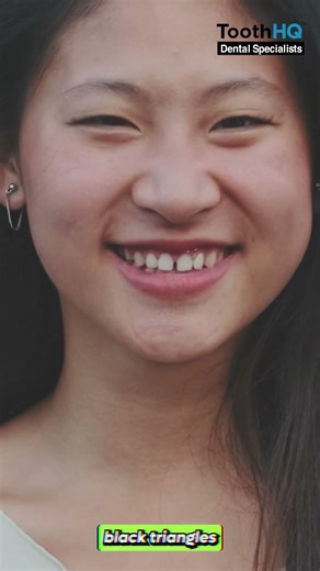 Does flossing make the gaps between your teeth bigger