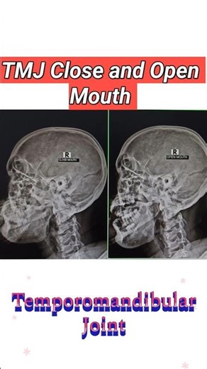 TMJ Close and Open Mouth view X-Ray