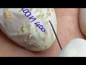 Relax with blackhead extraction (400) | Loan nguyen