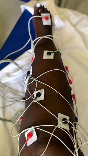 Lymphedema 2 Months Post Surgery Transformation