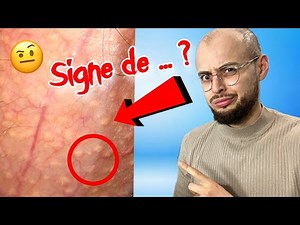 C'est quoi ça ? Boutons blancs sur le penis, ce n’est pas de l’herpès !