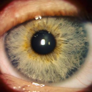 Hippus is the normal rhythmic fluctuations of the pupil as the pupil dilates and constricts. | Dr. Muhammad Raees