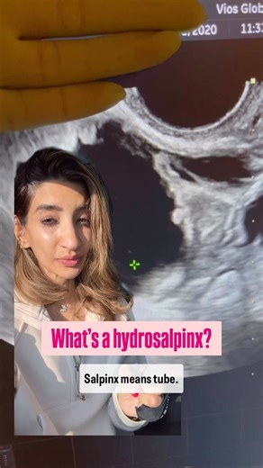 Roohi Jeelani on Instagram: "💧 What is Hydrosalpinx? Hydrosalpinx is when one of your fallopian tubes becomes blocked and fills up with fluid. This often happens due to past infections like chlamydia, endometriosis, or prior pelvic surgeries that cause scarring. 🩺 Why does it matter for fertility? The fluid inside a hydrosalpinx can leak into the uterus. Studies show this fluid can be toxic to embryos and lower your chances of getting pregnant, even with IVF. In fact, having a hydrosalpinx can