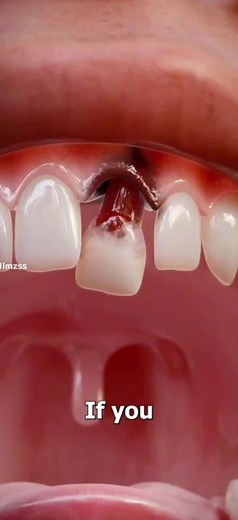 What Happens If You Swallow Your Tooth?