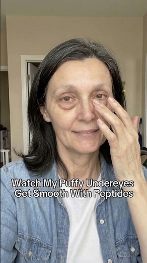Watch My Puffy Undereyes Get Smooth With Peptides (Raw 2-Minute Test)
