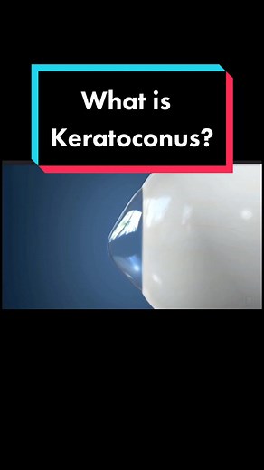 Understanding Keratoconus: Causes and Treatment Options