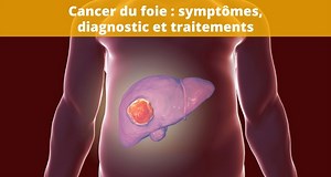 Cancer du foie - Symptomes, diagnostic, traitements et espérance de vie