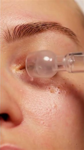 Delicate Under-Eye Pore Extraction | Ultra Close-Up ASMR Suction #asmr #skincare
